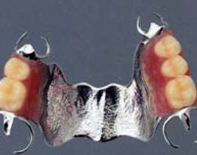 チタンの部分義歯